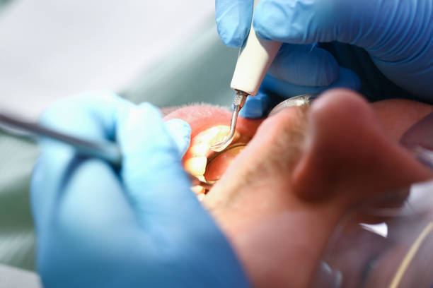 Best Emergency Dentist for Knocked-Out Tooth in Palm Beach, FL