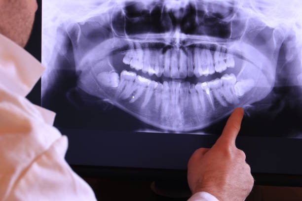 Best Emergency Dentist for Lost Fillings or Crowns in Palm Beach, FL